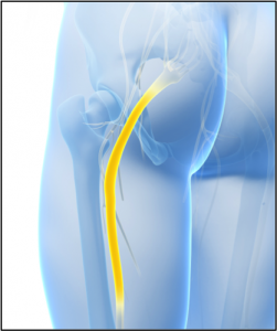 Sciatica - piriformis syndrome treatment